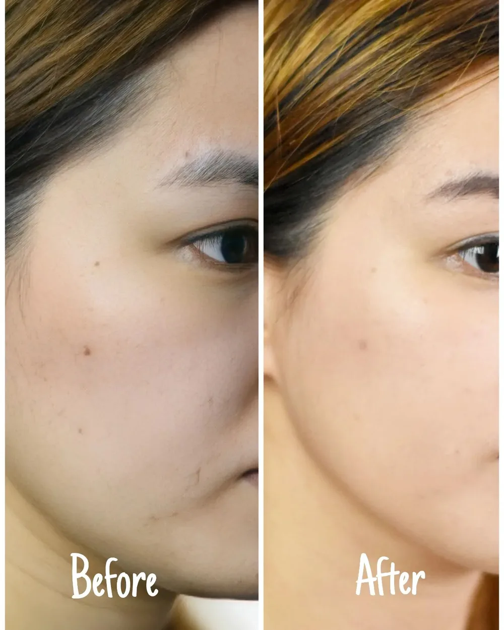 It's been 2 weeks since I've first used Chiyou Sucral Overnight Solution Cream and it really lightened my acne scar! I will definitely use this for more improvement!
This cream is one of the lightest cream I've ever tried. I sometimes use it just on the affected spot, but I also sometimes use it on my whole face! No sticky and heavy feeling. Made of sucralfate as its main ingredient that makes the cream effective in treating inflammation. Sucralfate has 10 times more effect than Cica on soothing and protecting the skin. Best used with Chiyou Terpineol Double Action Serum for faster and better effectiveness! This is dermatology tested so no need to worry about trying it out!
Good news! You can enjoy this amazing deal in shopee until July 31!
- Get the single item for Php870.00 and the set for Php1550.00
- Buy 2 and get extra 5% off
https://shopee.ph/fromchiyou
I definitely recommend getting the set!
#CICAUpgraded #SOSCream #ScarEraser #confidentwithchiyou #CHIYOUSKIN #charisceleb
@chiyouskin